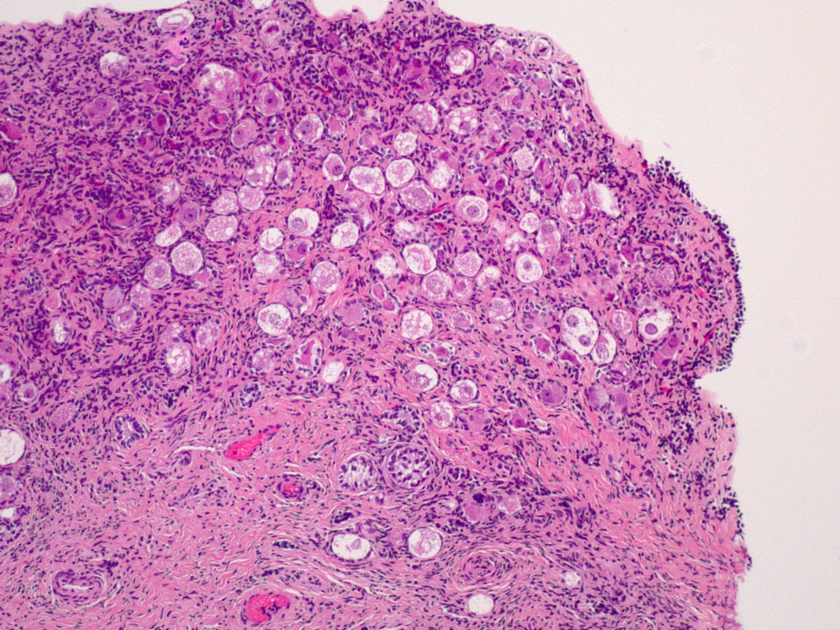 Gonadal biopsy in 4-month-old phenotypic male, 46XX
#pedipath #gynpath #gupath #DSD