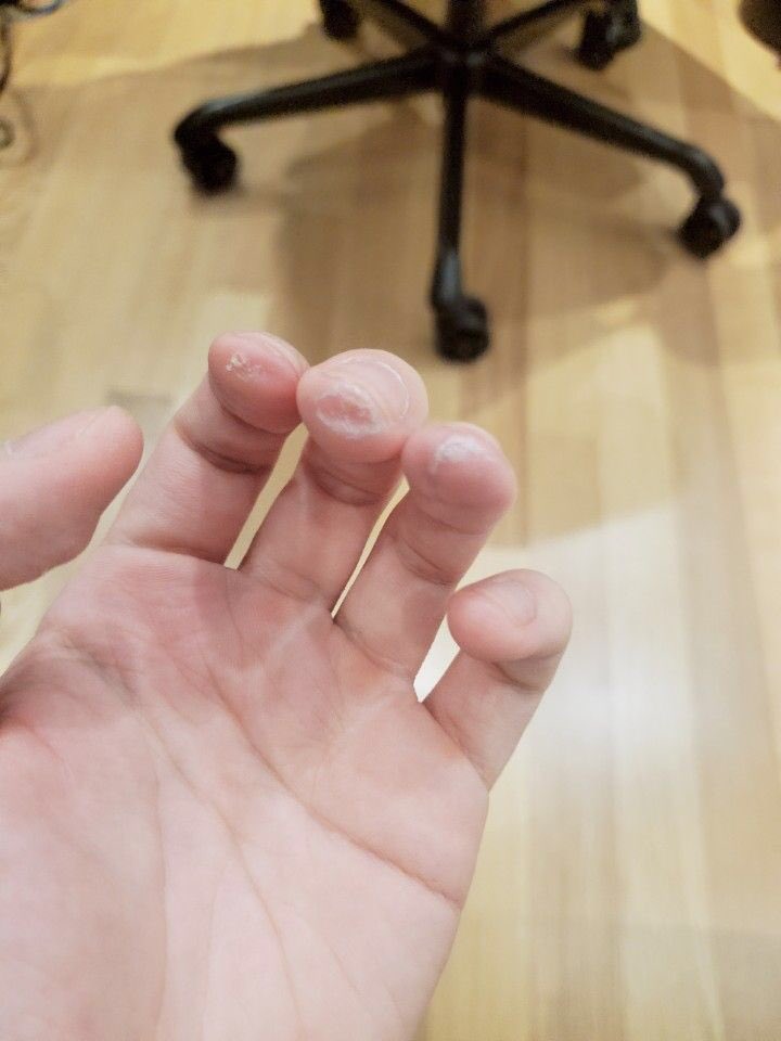 Yesterday he posted this photo of his fingers after his guitar.