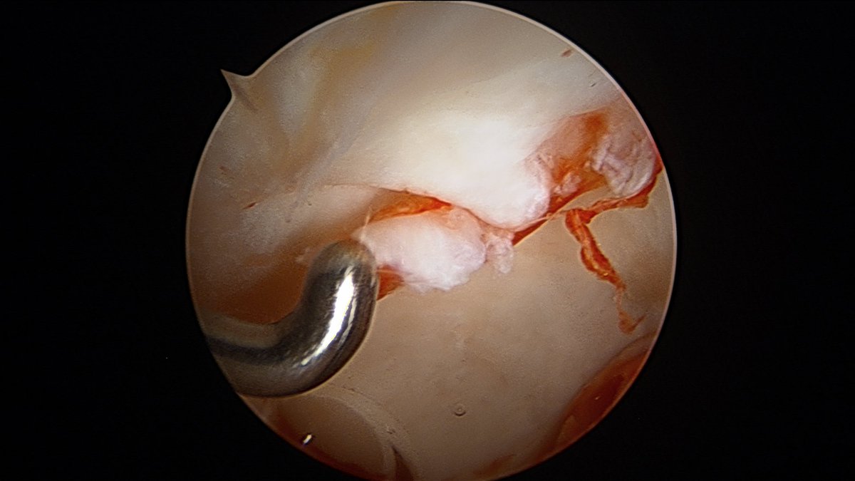 So, most  #HipArthroscopy for labral tears should INCLUDE correction of the underlying cause.So, if a patient has a labral tear like this...