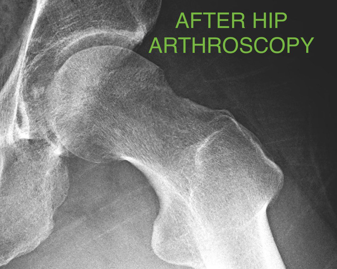 Surgeons started to incorporate the findings of Ganz into the burgeoning field of  #HipArthroscopy.Techniques were developed to mimic the Ganz open surgical dislocation, but with a minimally invasive approach.Here’s the same hip after a hip scope.