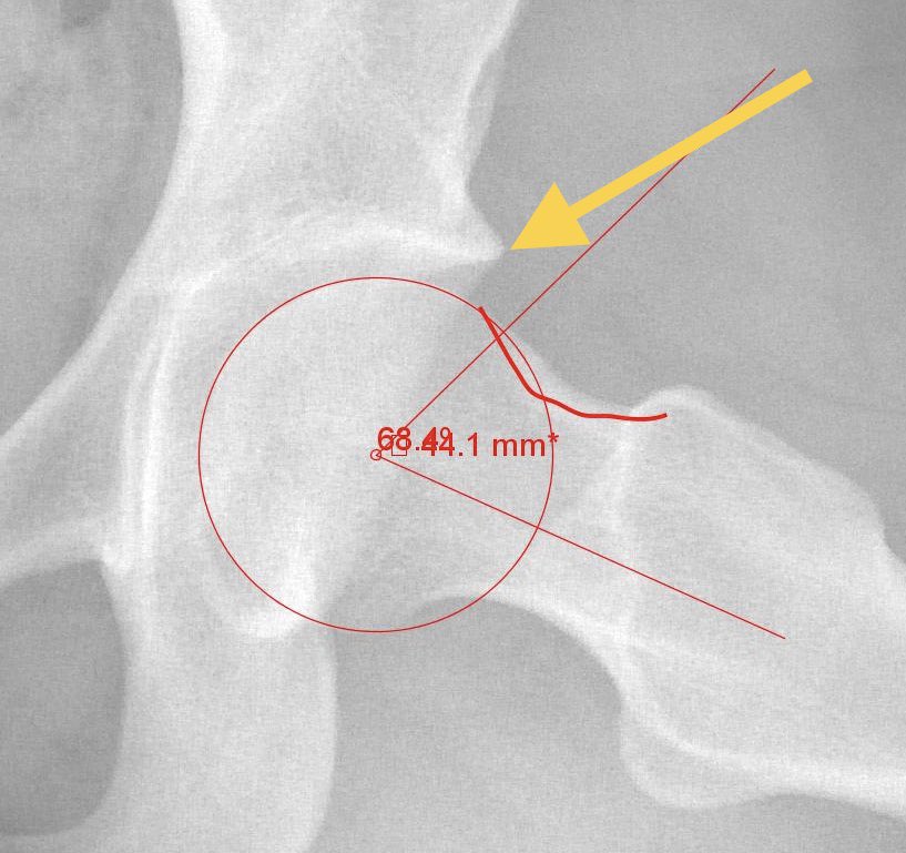 The surgeon needs to carefully evaluate the bony structure (same patient’s X-Rays, which shows an increased alpha angle (cam  #HipFAI) and extra bone off the acetabulum (pincer-yellow arrow)