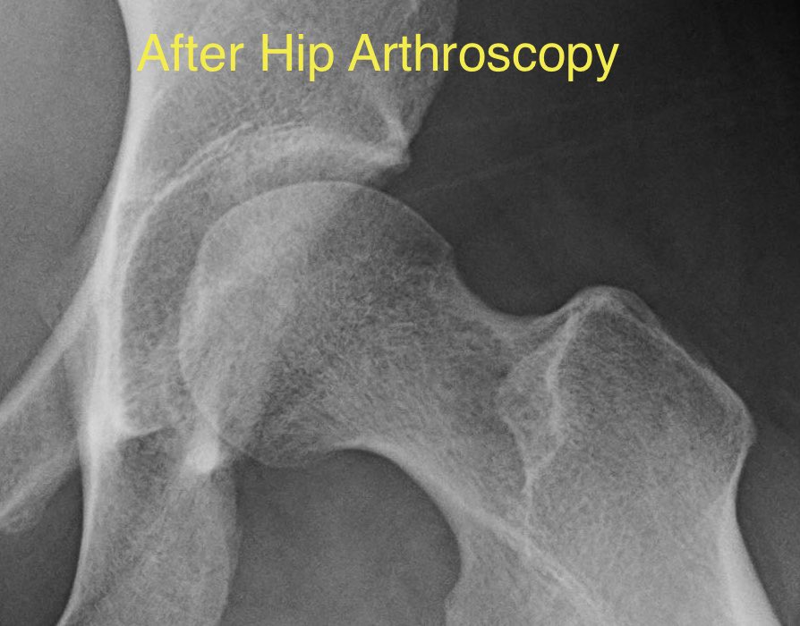 For this labral tear, optimal results occur when addressing the labral tear and addressing the cause of the damage.  #HipArthroscopy pic showing repaired labral. X-ray showing surgical correction of  #HipFAI.