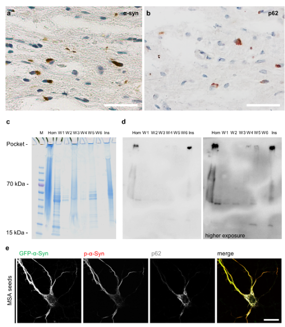 ScienceofPD's tweet photo. New @biorxivpreprint from @victoriatrinka1 @ruferbus & colleagues suggests that #Parkinsons-associated "neuronal α-synuclein inclusions contain α-synuclein fibrils intermixed with cellular membranes, & illuminate the mechanism of aggregate nucleation"
https://t.co/sKvM5VnIOO https://t.co/qwDJajJGsU