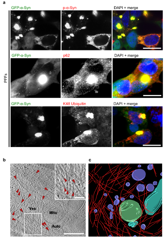 ScienceofPD's tweet photo. New @biorxivpreprint from @victoriatrinka1 @ruferbus & colleagues suggests that #Parkinsons-associated "neuronal α-synuclein inclusions contain α-synuclein fibrils intermixed with cellular membranes, & illuminate the mechanism of aggregate nucleation"
https://t.co/sKvM5VnIOO https://t.co/qwDJajJGsU