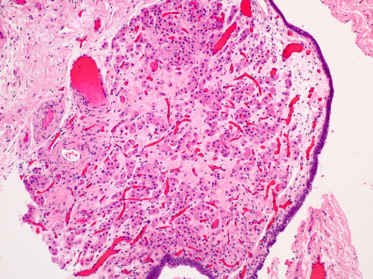 Dr_Brian_Cox's tweet image. Eosinophilic cells in a cystectomy. Patient has BRCA1/2 mutation.  History of RCC.