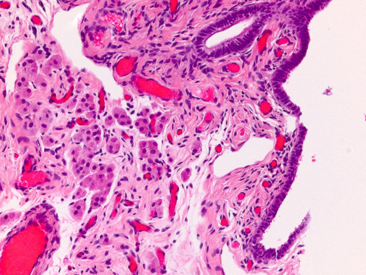 Dr_Brian_Cox's tweet image. Eosinophilic cells in a cystectomy. Patient has BRCA1/2 mutation.  History of RCC.