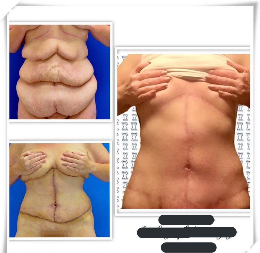 Plastic Surgery Consultant On Twitter A Corset Body Lift Provides Dramatic Changes By Pulling Loose Abdominal Skin In The Midline Of The Abdomen From Between The Breasts To The Pubic Hairline