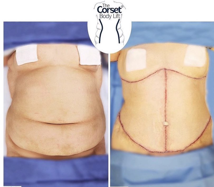 Plastic Surgery Consultant On Twitter A Corset Body Lift Provides Dramatic Changes By Pulling Loose Abdominal Skin In The Midline Of The Abdomen From Between The Breasts To The Pubic Hairline