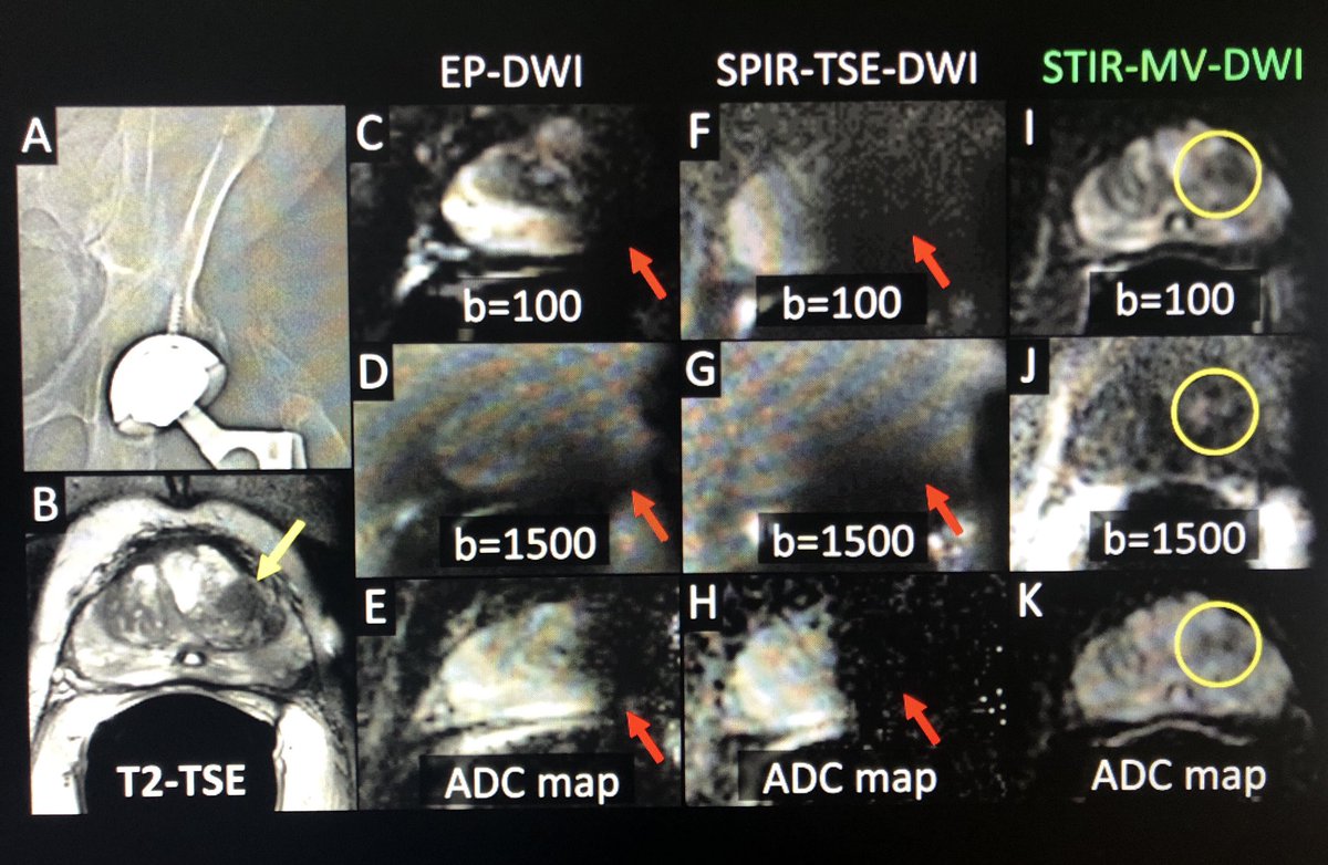 Ivan Pedrosa (@ivpedrosa) on Twitter photo We have used ‘radial’ k-space sampling (MultiVane), short-tau inversion-recovery (STIR) fat suppression, and split acquisition of turbo spin-echo signals (SPLICE). Such improvement in signal recovery that <a href="/pirastium/">Ali Pirasteh</a> nicknamed it Event Horizon. #ISMRM2018 pubmed.ncbi.nlm.nih.gov/32697522/ We have used ‘radial’ k-space sampling (MultiVane), short-tau inversion-recovery (STIR) fat suppression, and split acquisition of turbo spin-echo signals (SPLICE). Such improvement in signal recovery that <a href="/pirastium/">Ali Pirasteh</a> nicknamed it Event Horizon. #ISMRM2018 pubmed.ncbi.nlm.nih.gov/32697522/