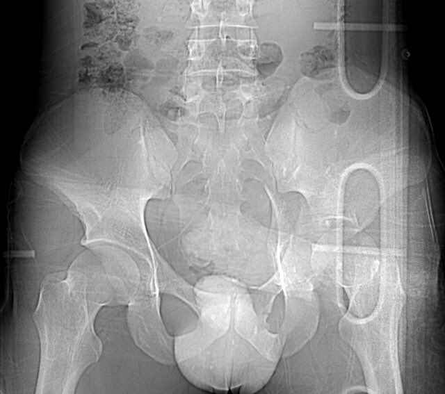 Isolated injury in a 38yo male driver after an automobile crash - can you identify the radiographic lines and fracture pattern?