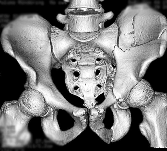The surface rendered CT helps “to see” the AP plain film better