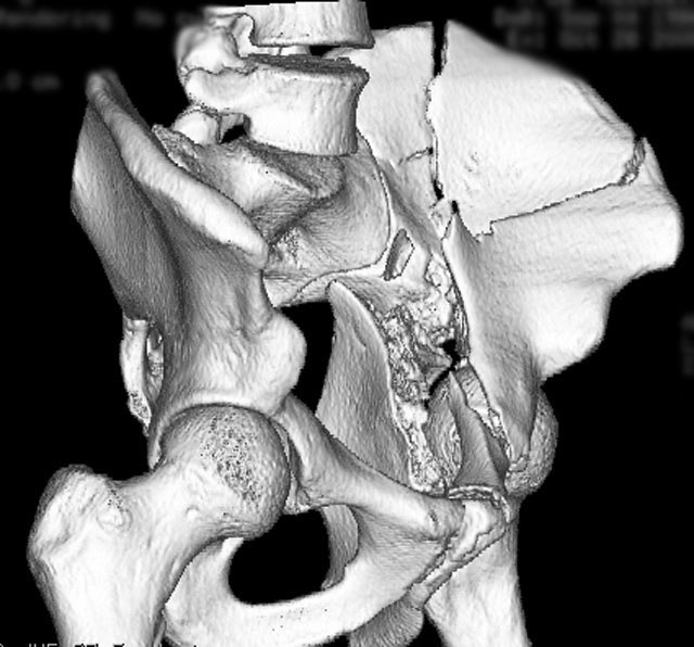 The iliac oblique SR image helps too