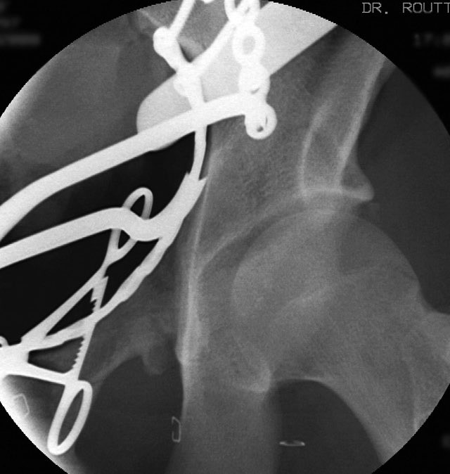Then reduced and clamped and stabilized the dome AC fragment