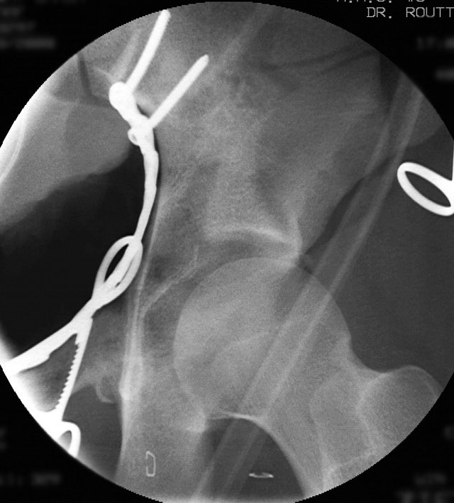 We used a regular table and an Ilioinguinal exposure to first reduce and stabilize the PC fragment to the intact ilium
