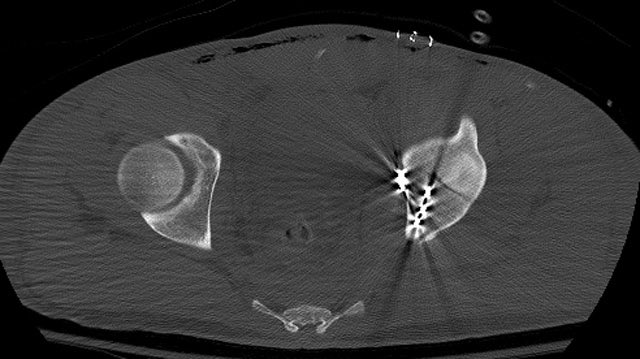 The postop CT helps us assess and understand the articular reduction and implant applications best