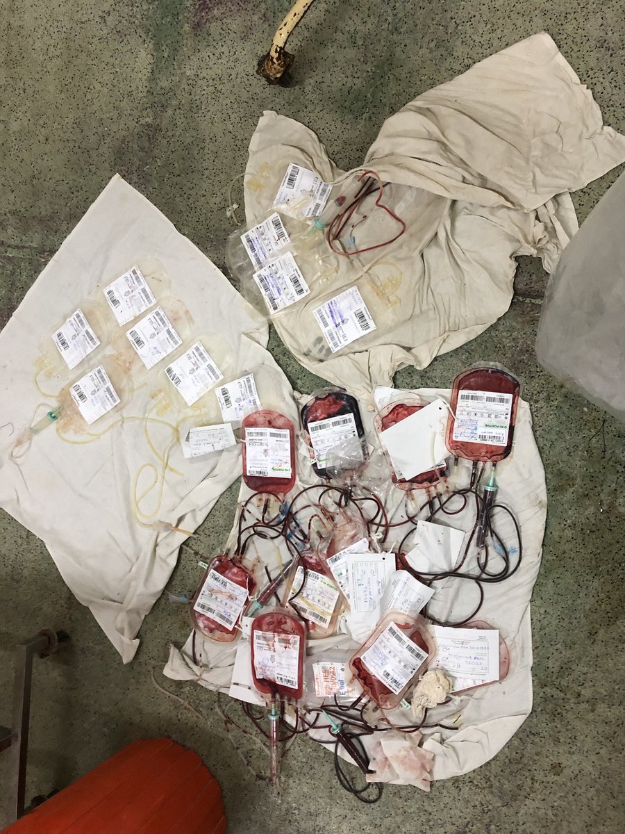 drthusharadw's tweet photo. Massive transfusion for a pt with a liver laceration following a RTA. Successfully packed and came back. #Damagecontrol #surgery #SoMe4Surgery #Surgicalresidency #SriLanka #NCTH https://t.co/q1W5jrR92W
