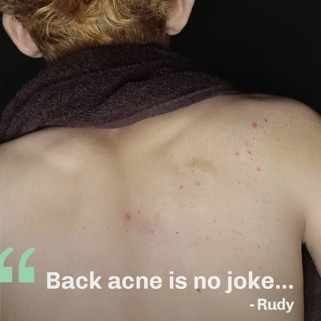 Oxecure_PH's tweet photo. "Back acne is no joke!” Is Oxecure the solution to @iamnotarudeboyy’s body acne problems? Stay tuned to see his results 👀💚 #OxecureStories #SkinUnfiltered https://t.co/HEh0cC8ijb