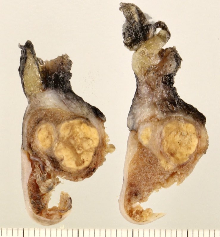 Quiroga_GM's tweet image. Yellow, well circumscribed intratesticular nodule. Sometimes, you have to think something other than GCN or SCS...
Adrenal cortical rest #gupath