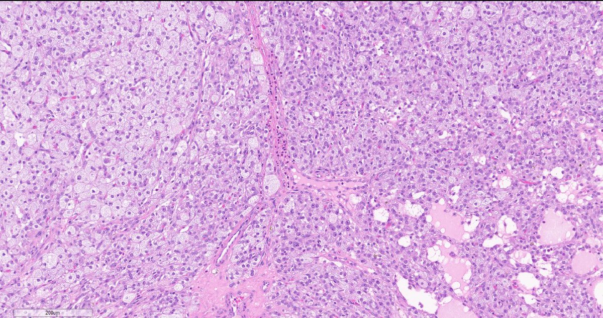 Quiroga_GM's tweet image. Yellow, well circumscribed intratesticular nodule. Sometimes, you have to think something other than GCN or SCS...
Adrenal cortical rest #gupath