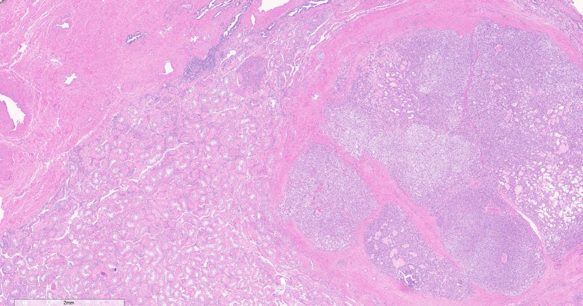 Quiroga_GM's tweet image. Yellow, well circumscribed intratesticular nodule. Sometimes, you have to think something other than GCN or SCS...
Adrenal cortical rest #gupath