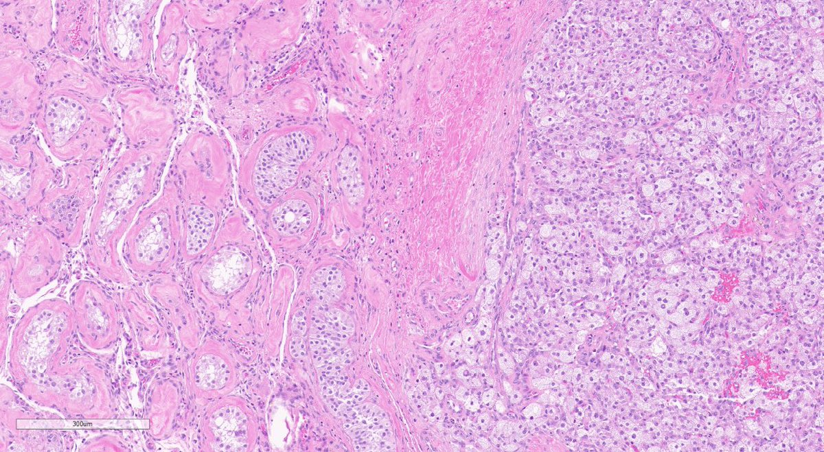 Quiroga_GM's tweet image. Yellow, well circumscribed intratesticular nodule. Sometimes, you have to think something other than GCN or SCS...
Adrenal cortical rest #gupath