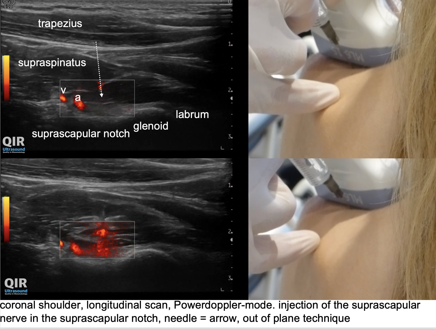 Swiss Ultrasound Center UZR on "Musculoskeletal Ultrasound – Shoulder – Suprascapular nerve injection. Out of plane Video: Suprascapular nerve anatomy https://t.co/61gFzRhIn4 Video: Suprascapular nerve injection https://t.co ...