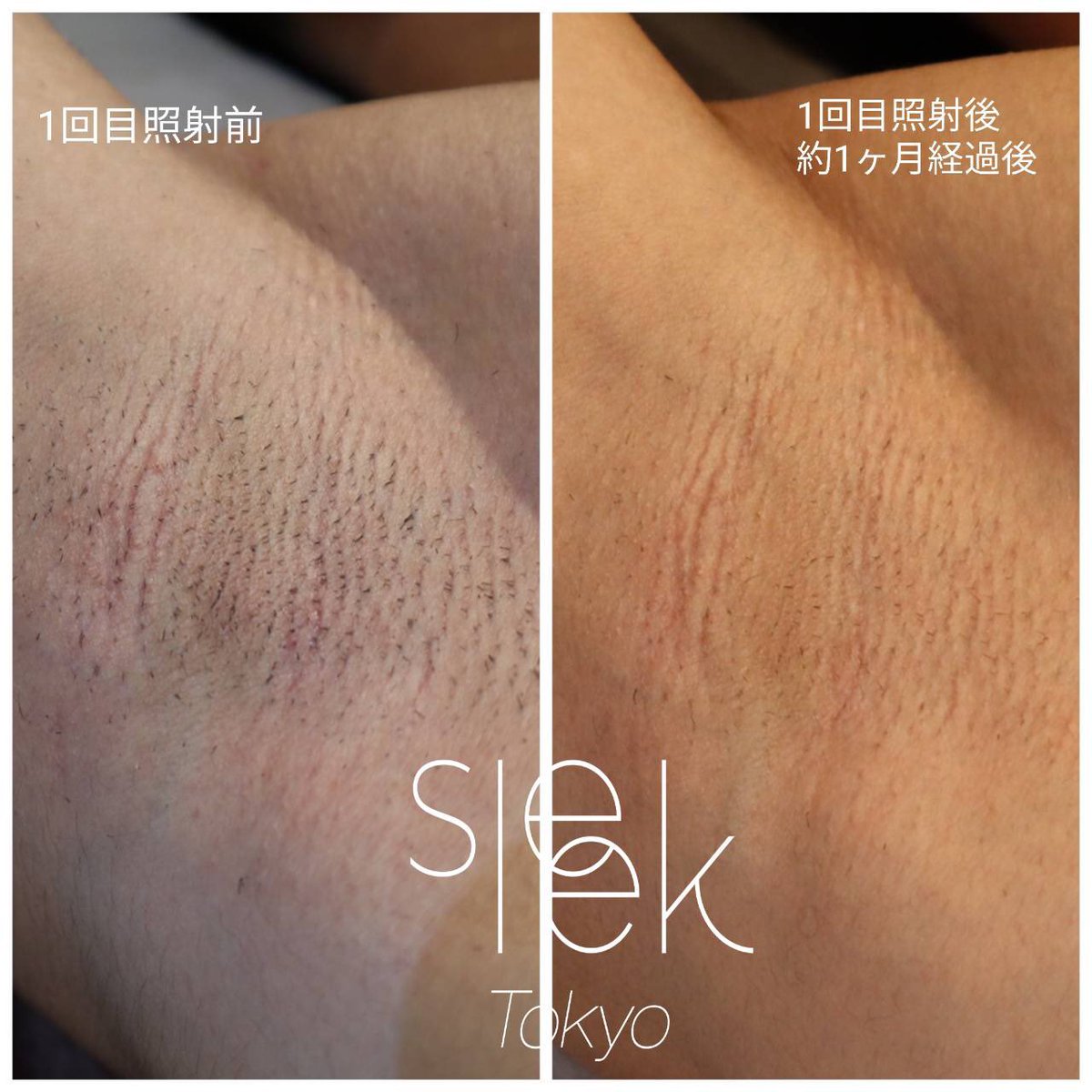 Sleektokyo 2回目の全身脱毛で Naasuke Fit さんにご来店いただきました 早速効果を実感されているとの事で良かったです お得なキャンペーン継続中なので脱毛にご興味ありましたら是非 メンズ脱毛 Sleektokyo Sleektokyo 2回目の全身脱毛で Naasuke Fit さんにご来店いただきました 早速効果を実感されているとの事で良かったです お得なキャンペーン継続中なので脱毛にご興味ありましたら是非 メンズ脱毛 Sleektokyo