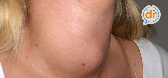 Faktanya wanita lebih rentan terhadap gangguan tiroid daripada pria dan lebih cenderung mengembangkan gondok : buff.ly/2VFWxbq.