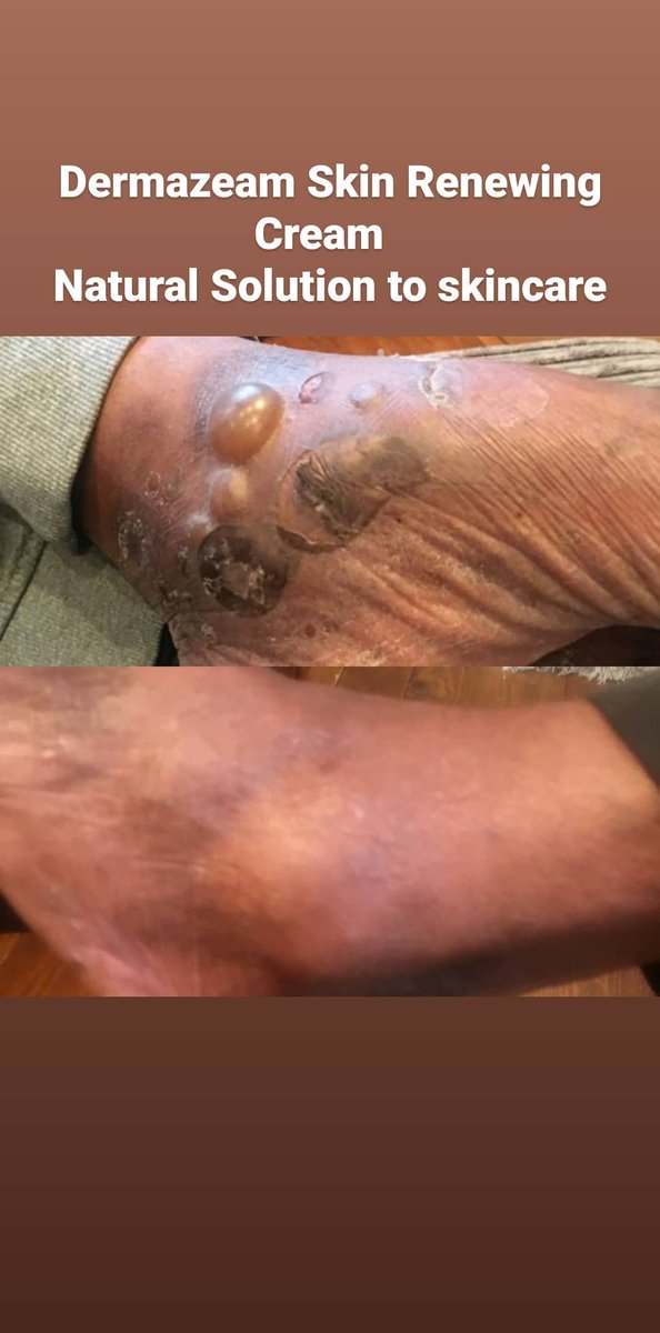 We are a family run business creating natural skincare for problematic skin.

On 4th July our customer approached us with his skin complaint. We recommended applying our Dermazeam Skin Renewing Cream twice a day. Yesterday he was pleased to present the results after 3 weeks.