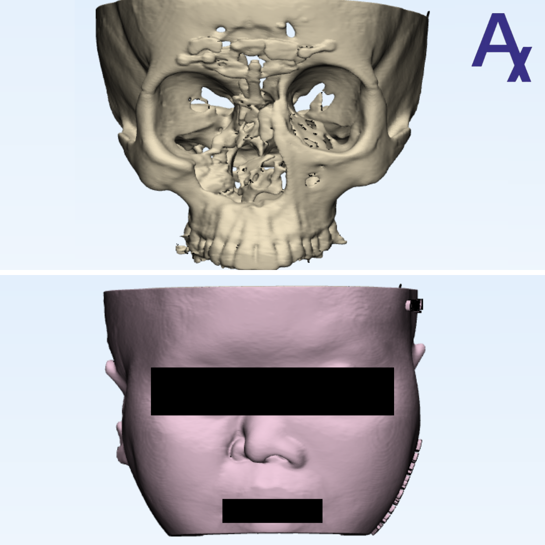 Anatomiz3D's tweet photo. To study and pre-plan for the surgery of fractured nasal bone and orbital floor, the team used a 3D printed model. The pathology 3D model, along with the soft tissue, was beneficial in understanding the anatomy and spatial relationship, along with reducing OT time.

#Healthcare https://t.co/DeNjo7RuFA