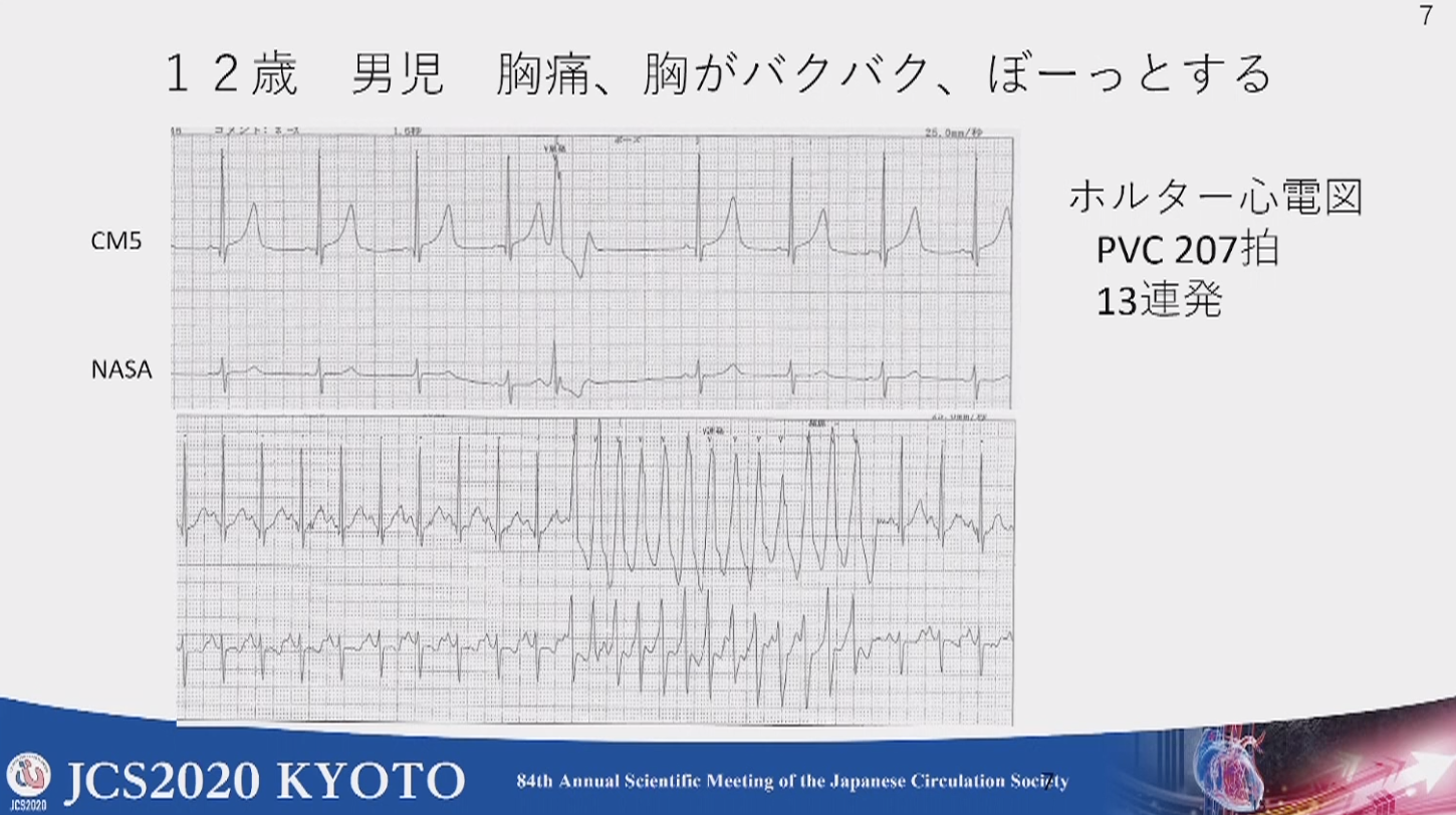 福田めもり ｲﾗｽﾄ産業医 循環器内科医 On Twitter 学校心臓検診を活かす 小児突然死予防に果たす役割 不整脈 Qt 延長症候群等 青木 寿明先生 学校検診で診断される代表疾患と突然死 頻度とリスクの表でわかりやすい Wpw症候群の突然死or心室細動 小児