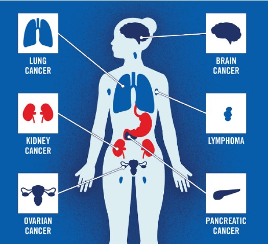 thrombosisday's tweet photo. Patients with #cancer at an increased risk of developing venous thromboembolism (#VTE) and certain types of cancer are associated with a higher risk of developing #bloodclots. 

To learn more about cancer associated thrombosis, visit: https://t.co/duUx5BE71L https://t.co/mMnSCg0EMi