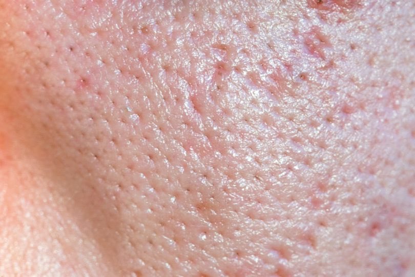 “My pores besar gila, jelas sangat nampak”“My skin lately berminyak sangat, excess oil tu lagi banyak compared to before”“Macam mana nak kecikkan pores”Tonight, I will be covering about this one problem that many of us are concerned about: Enlarged pores!This is a thread 