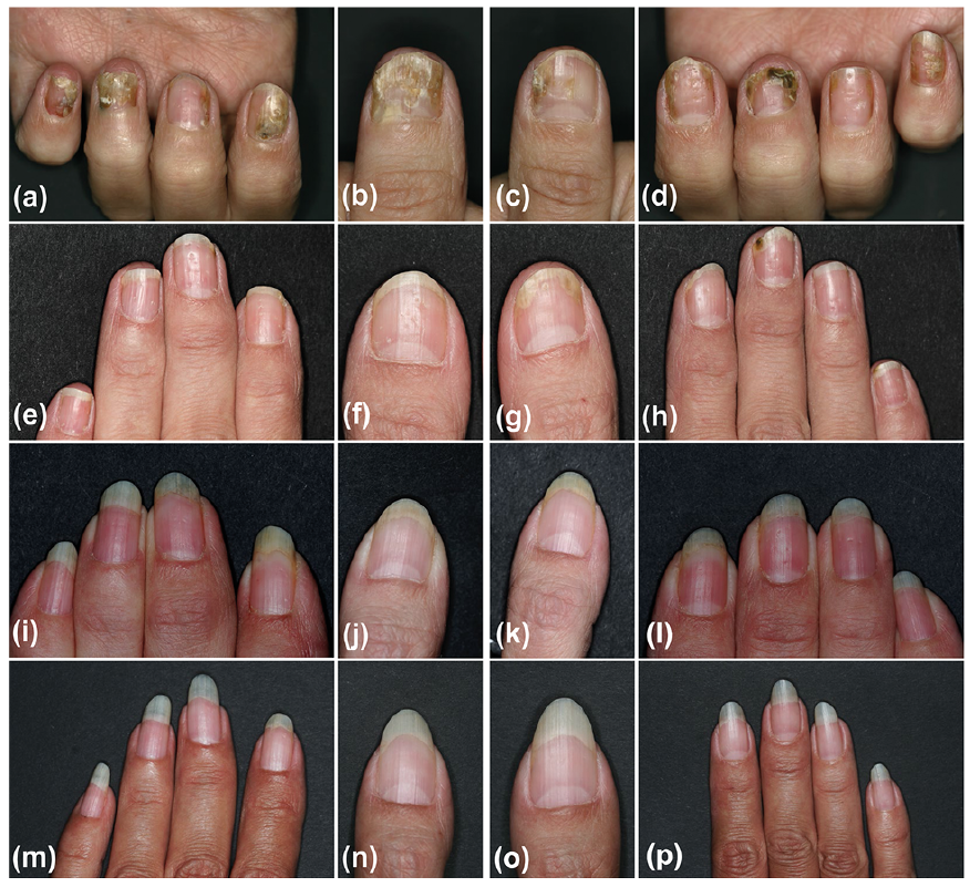 A new paper:
Efficacy of Adalimumab for Nail Psoriasis During 24 Months of Continuous Therapy
#psoriasis #nailpsoriasis #nailpsoriasisseverityindex #DermatologyLifeQualityIndex #adalimumab
medicaljournals.se/acta/content/h…