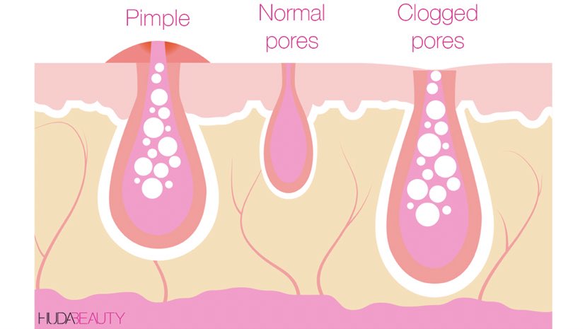 “So, apa yang menyebabkan pores kita nampak besar ye?”1.EXCESSIVE SEBUMThis one happens when sebaceous gland produce lots of oil more than it should, usually those with oily skin la camni2.KURANG ELASTICITY AROUND THE PORESWhen our skin dah tak tegang, pores nampak enlarged