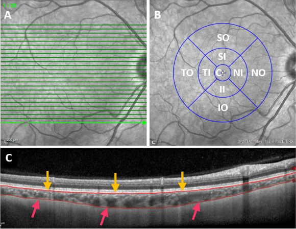 lajoscs's tweet photo. Make sure you check out my virtual poster today at #AAIC20 #AAIC2020 on choroidal changes in #DownSyndrome, a patient population that is particularly susceptible to #Alzheimers disease. Registration is free of charge!!! #OCTEDI #spectralis
@Drusen_Lengyel
@WWIEM_QUB https://t.co/a0xFofoKOb