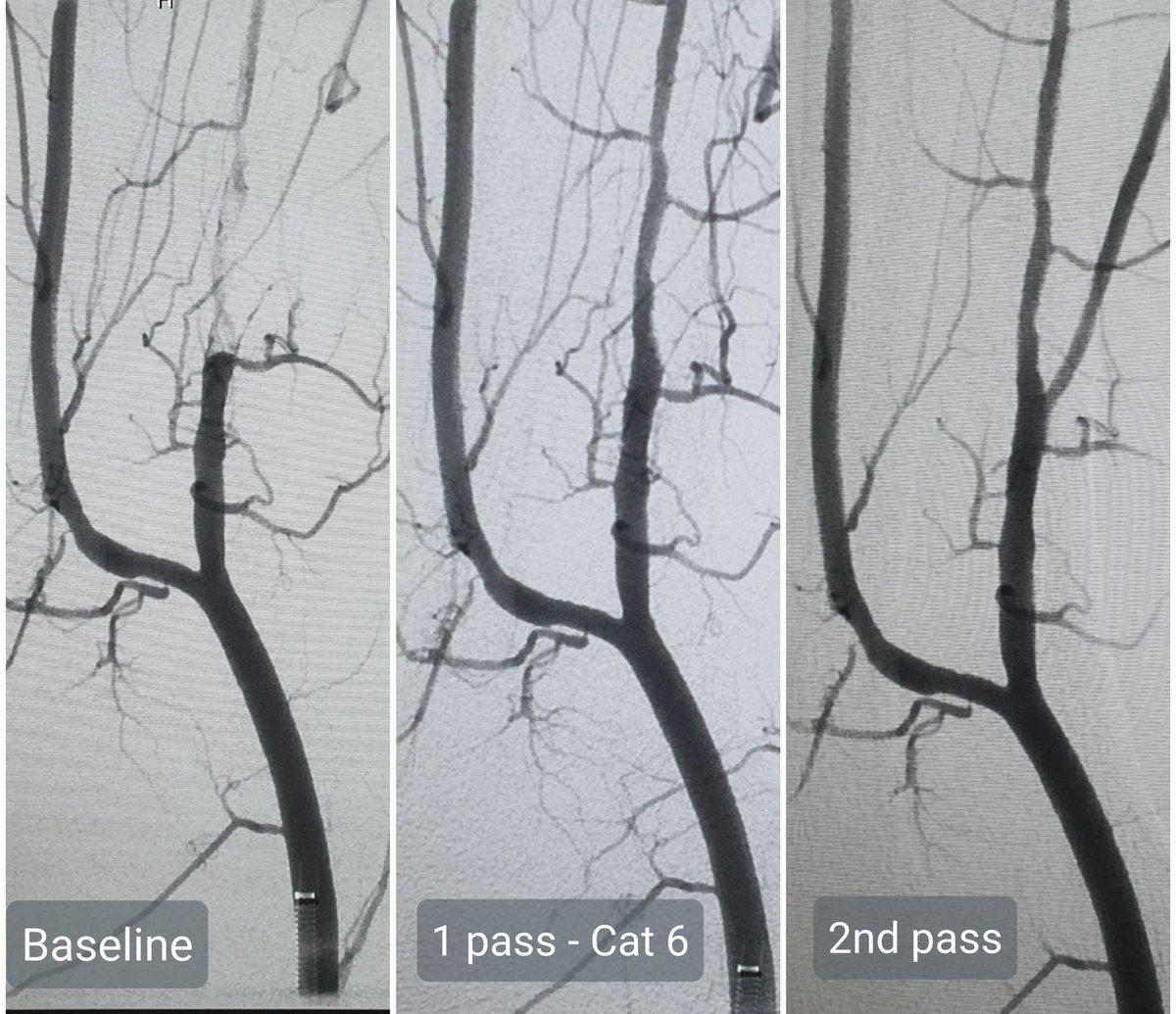 drgauravgangwni's tweet photo. 67 yr old male post covid recovery presented to IR with left foot acute to subacute ischemia. 5th digit gangrene &amp; rest pain. Inspired by @VenuVadlamudiMD and @t_intheleadcoat - took to Cat6. Recanalised TP trunk, proximal peroneal and PTA. Left infusion for distal emboli. https://t.co/d5232SOVrW