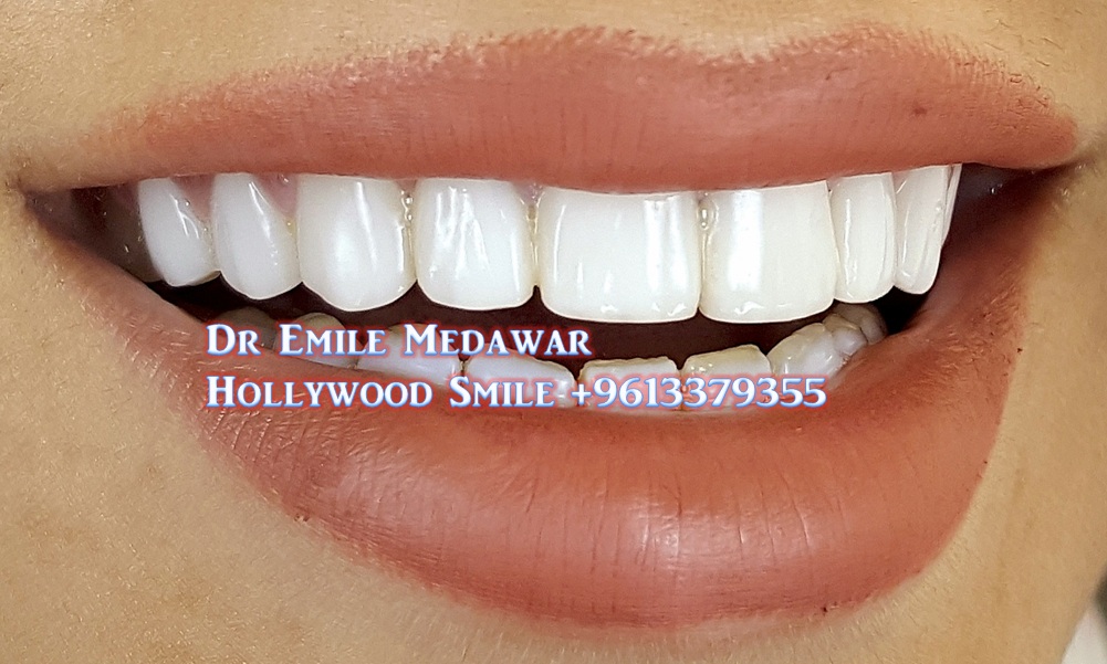 veneerlebanon's tweet photo. #SmileDesigner Dr Emile Medawar #CosmeticDentist #DentalImplants #Surgeon #OralSurgery #Specialist #Lebanon #Beirut #SinElFil +961 3 379355
#PorcelainVeneers #DirectCompositeVeneers #VeneersCost #SmileCelebrity #TeethWhitening
emile_medawar@hotmail.com
https://t.co/g05w0YKWg7 https://t.co/RN6PyVsuEA