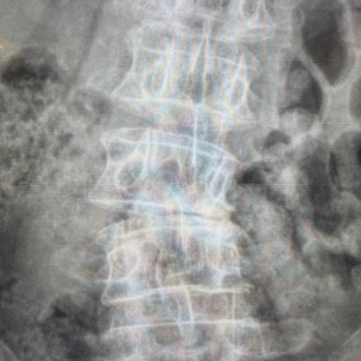medcomtech_sa's tweet photo. Esta mañana en el Hospital de Manacor el Dr.Rius y el Dr.Marimon
han hecho un XLIF a una paciente de 72 años operada hace 20 con sindrome postdiscal. Han utilizado una caja Stalif L de @Centinelespine y un separador @tedansurgical 
#cirugiadecolumna 
#raquis
#siempreconlosmedicos https://t.co/MKG8lBEq9I