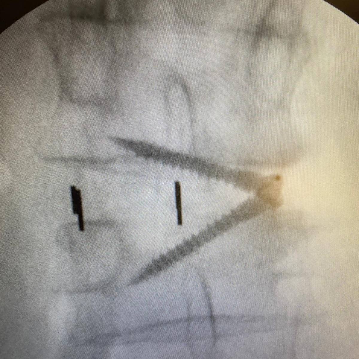 medcomtech_sa's tweet photo. Esta mañana en el Hospital de Manacor el Dr.Rius y el Dr.Marimon
han hecho un XLIF a una paciente de 72 años operada hace 20 con sindrome postdiscal. Han utilizado una caja Stalif L de @Centinelespine y un separador @tedansurgical 
#cirugiadecolumna 
#raquis
#siempreconlosmedicos https://t.co/MKG8lBEq9I