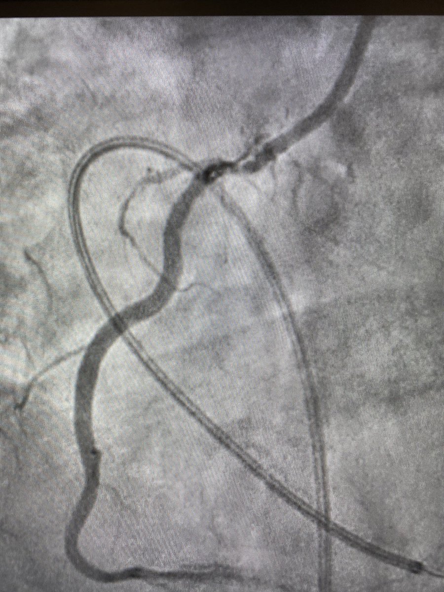 BhallaMd's tweet image. Good ole Rotablator. Always does a phenomenal job on ostial calcium #rotapro @BSCCardiology