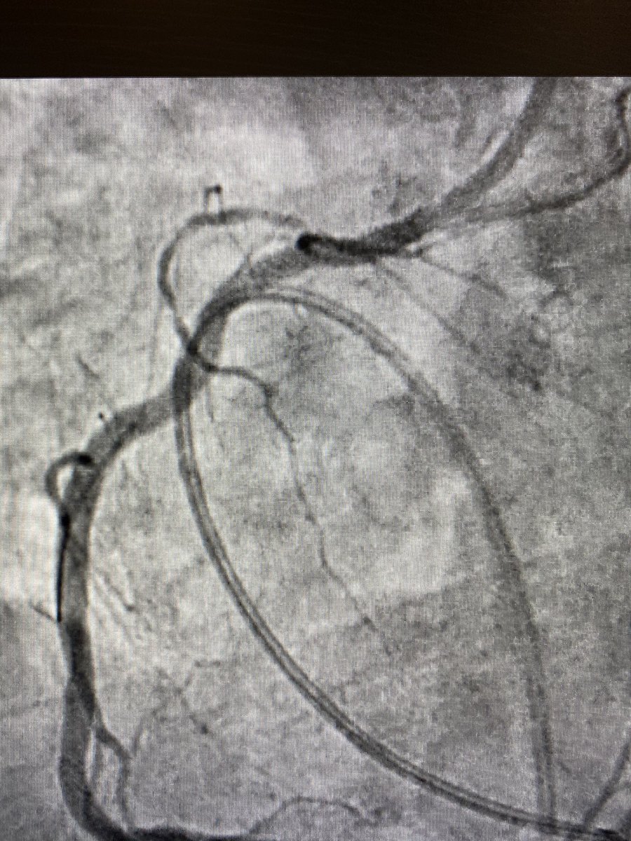 BhallaMd's tweet image. Good ole Rotablator. Always does a phenomenal job on ostial calcium #rotapro @BSCCardiology