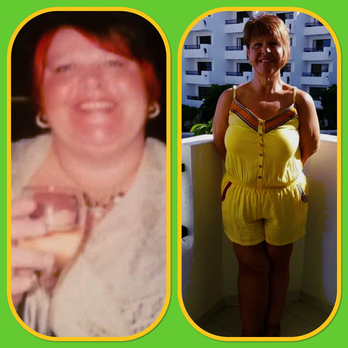7792_44's tweet photo. Wls surgery is a toole to successful weight loss in the obese person #bariatric surgery works# life changing #20st loss@
@MaxPemberton @AnnVincent1 @itvnews @BorisJohnson @solveigsig @BramleyMandy1 @EASOobesity @RCPLondon @BrocqSarah @ZaherToumi https://t.co/wwjwpqTi7x