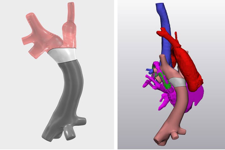 Lynn_Allen's tweet photo. Using engineering tools from the aerospace industry to repair hearts!
https://t.co/yIFiRVEqTF  @Dassault3DS @BostonChildrens https://t.co/QX9suPB9t1