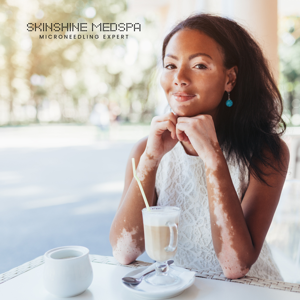 SkinShineMedSpa's tweet photo. The next best thing to a cure for vitiligo is semi-permanent makeup. This treatment is safe and effective without any side effects. 

#skincare #vitiligo #beauty #permanentmakeup #skin #skincareproducts #cosmetics #skinshinebar #skinshinemedspa https://t.co/SF75SkrO8a