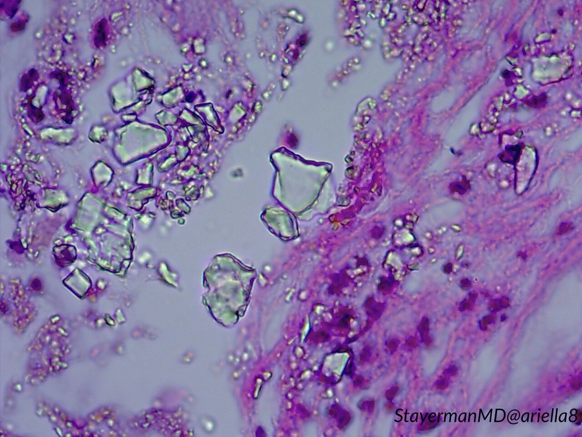 ariella8's tweet photo. #GIPath #Pathartefacts #Medicalforeignbodies https://t.co/UyshHx6uEr