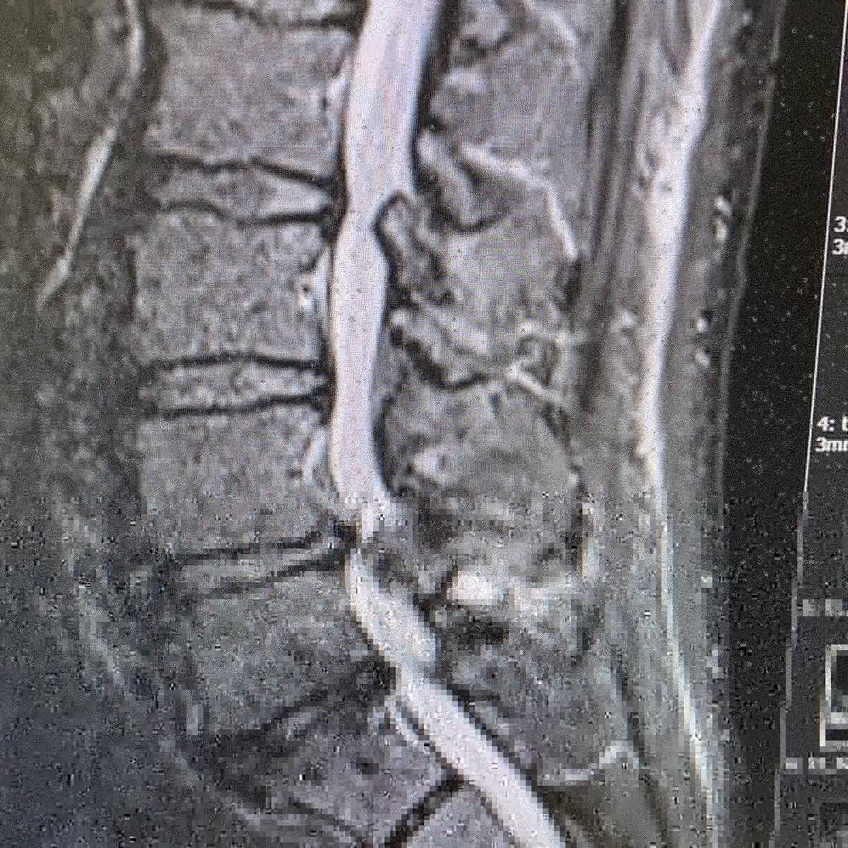 medcomtech_sa's tweet photo. Un caso para MOSS100 y TelixK de Biedermann hoy en Clinica Corachan con Dr Fuster y su equipo.
Paciente 62 años, con artrosis, estenosis de canal y radiculopatía lateral derecha, pruebas funcionales con 0 inestabilitad.Artrodesis L4-S1 con dispositivo intersomatico L5-S1. https://t.co/qCIPlb5xkJ
