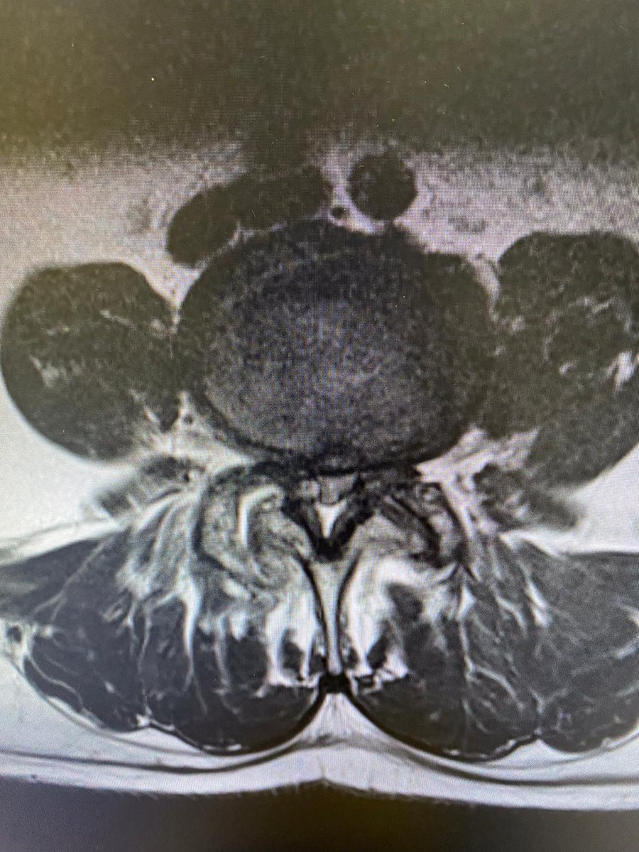 medcomtech_sa's tweet photo. Un caso para MOSS100 y TelixK de Biedermann hoy en Clinica Corachan con Dr Fuster y su equipo.
Paciente 62 años, con artrosis, estenosis de canal y radiculopatía lateral derecha, pruebas funcionales con 0 inestabilitad.Artrodesis L4-S1 con dispositivo intersomatico L5-S1. https://t.co/qCIPlb5xkJ