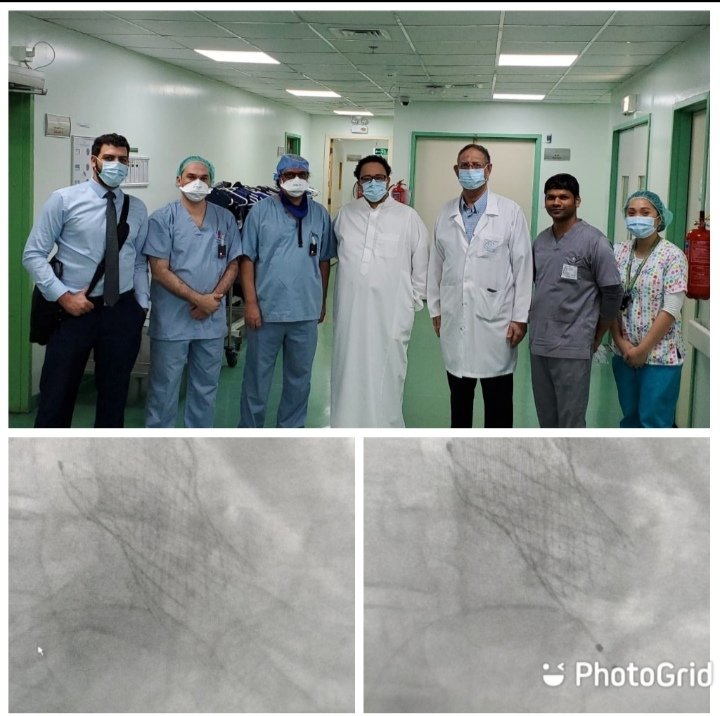 AlkashkariWail's tweet photo. Two successful TAVR in two high risk patients with EF<25%,heavily calcified valves, #evoluteR 29&34mm @Medtronic
#CUSPS_OVERLAP #Commissural_alignment,post dilation
No PVL, Gr4, no ECG changes.
@MIRVATALASNAG @bogamisa @khalidcvsurg @drsami5566 @Nabeelosis @bader1619 @johaniMD https://t.co/Qhgi8JWv8D
