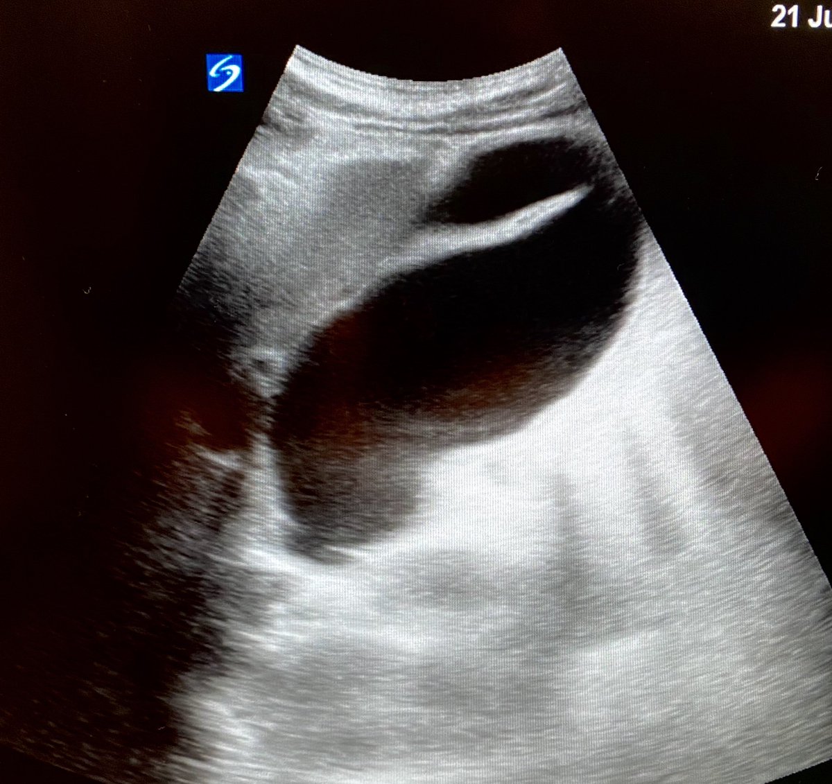 HeadtotoeSono's tweet photo. GB long/short axis views. Not necessarily abnormal. #Phrygian cap, #Normalvariants, #Acousticenhancement, #POCUS, @DoctorsEMres https://t.co/CvWf4Rybsy